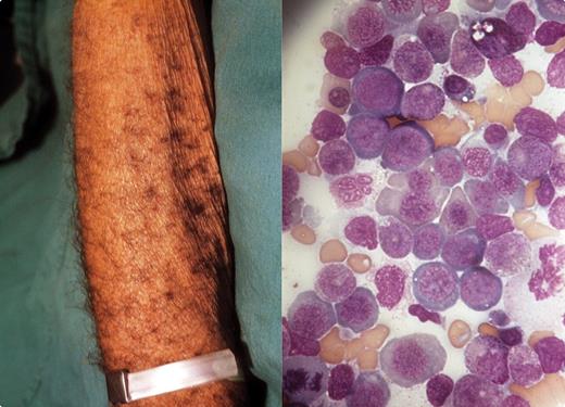 An elderly recluse gentleman was brought to the medical clinic for an assessment. He had pallor, a smooth tongue, a palpable spleen, and petechiae adjacent to hair follicles (left panel). Laboratory work showed a moderate macrocytic anemia and leukopenia and minimal thrombocytopenia. The peripheral smear illustrated a few macroovalocytes and hypersegmented polys. He described no ill health but reported a diet that was exclusively boiled egg whites, water, and infrequent sips of milk. He offered no reason for this diet. / His unusual diet and pancytopenia raised the possibility of a nutritional megaloblastic anemia that was confirmed on the marrow examination (right panel). His B12 level was low and folic acid was normal. One week after B12 (10 mcg IM), his reticulocyte count increased and his white count was normalizing. However, the petechiae persisted. Vitamin C deficiency was suspected and an ascorbate blood level was noted to be rather low. High-dose oral ascorbate was started and the perifollicular petechiae disappeared in a week. Diarrhea occurred but was controlled with a lower dose of ascorbate. Psychosocial services became involved to assist with his home life and diet. / Scurvy has been known for centuries. In the late 1700s, the British Navy, aware that scurvy was cured by eating citrus, required the consumption of limes, lemons, and oranges on its ships; hence the sailors were known as Limeys.