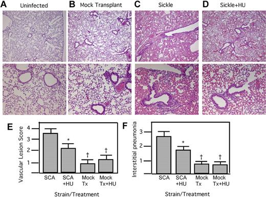 Figure 2. Histopathology of SCA lungs after pneumococcal challenge. (A-D) H&E-stained lung sections at 18 hours after infection: control without infection (A); mock transplanted, infected, saline treated (B); SCA, infected, saline treated (C); and SCA infected receiving hydroxyurea (HU; D). Magnification: top row, ×4; bottom row, ×10. (E) Mean vascular lesion scores of SCA and mock-transplanted (Tx) mice receiving HU or saline therapy at 24 hours after challenge (n = 5/group). (F) Quantification of the signs of interstitial pneumonia determined by histologic examination of lung sections at 24 hours after infection (n = 5 mice/group; mean = 3.7 ± 0.5 for SCA saline, 2.6 ± 0.4 for SCA + HU; *P < .05 compared with SCA, †P < .05 compared with SCA+HU using Mann-Whitney).