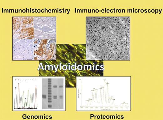 Apple-green birefringence of fibrillar protein deposits is the sine qua non of amyloidosis. To type amyloid fibrils and guide appropriate therapeutic decision-making, a variety of specialized techniques may be employed, collectively here termed “amyloidomics.” These include immunologic techniques such as immunohistochemistry or immuno-electron microscopy; genomics techniques including analysis of restriction fragment linked polymorphisms (RFLPs), single nucleotide polymorphisms (SNPs), or gene sequencing; or mass spectrometry-based proteomics techniques such as the one described by Brambilla et al in this issue.1 (Examples of diagnostic techniques courtesy of Drs Skinner, Connors, O'Hara, Costello, and colleagues in the Gerry Amyloid Reference Laboratory at Boston Medical Center.)