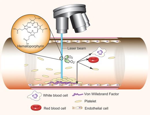 Study of details of thrombus formation at the single-cell level. Irradiation of hematoporphyrin with a 488-nm laser beam results in production of reactive oxygen species (ROS), mainly O2−. Free radicals activate all cells present in the irradiated field—white blood cells, red blood cells, and platelets, but maily endothelial cells. Activated endothelial cells release von Willebrand factor (VWF), regulated through inflammatory cytokine signaling. Discoid platelets adhere to the activated endothelium through GP1bα-VWF interaction and form a platelet-rich, occlusive thrombus. Single-cell dynamics and thrombus formation details are visualized during laser excitation and ROS production. Professional illustration by Paulette Dennis.
