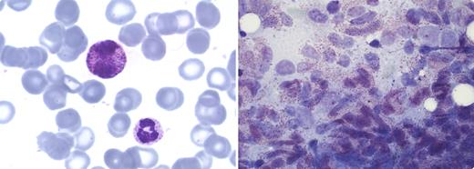 A 45-year-old woman was admitted with fatigue, icterus, thrombocytopenia (77 × 109/L), normocytic anemia (9.8 g/dL), and a normal white blood cell count (8.5 × 109/L). The peripheral blood smear showed metamyelocytes, myelocytes, monocytes, erythroblasts, and atypical cells with bilobulated nuclei resembling basophil granulocytes (left panel of figure). In the bone marrow there was a nearly complete infiltration with atypical, partly degranulated mast cells expressing surface markers (CD2, CD25, and CD117; right panel of figure). These cells were also positive for c-KIT mutation (D816V). Tryptase levels in serum were elevated (719 μg/L, normal value: 0-11.4 μg/L) in the absence of symptoms arising from mediator release. / A diagnosis of aleukemic variant of mast cell leukemia was made because < 10% mast cells could be detected in peripheral blood. She had no skin lesions. Four weeks after starting treatment with high-dose chemotherapy, the patient died with Klebsiella pneumonia sepsis and multiorgan failure. Mast cell leukemia is a rare and very aggressive form of systemic mastocytosis. The prognosis is poor with a median survival of < 2 months.
