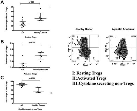 Figure 3. Treg subsets in AA. Treg subsets were studied in 11 AA patients (pretreatment with nonsevere disease) and 6 healthy donors. This figure shows the frequency of CD45RA+/− and Foxp3+/− subsets of Tregs. The frequency of Foxp3+ CD45RA− (active Tregs; population II and graph in panel B) and Foxp3−CD45RA+ (resting Tregs; population I and graph in panel A) was decreased in AA (P = .004, P = .01), whereas the frequency of Foxp3−CD45RA− subset (cytokine-secreting non-Tregs; population III and graph in panel C) was increased in AA compared with healthy donors (P = .003).
