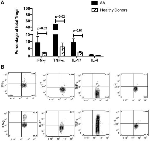 Figure 5. Cytokine secretion by Tregs in 5 AA patients and 3 healthy donors. (A) Amounts of IFN-γ, TNF-α, and IL-17 secreted by Tregs were significantly higher (P = .02, P = .02 and P = .01, respectively) in 5 AA patients than in 4 healthy donors, whereas the amount of secreted IL-4 was not significantly different between the 2. (B) An example of intracellular staining of AA and healthy donor Tregs for cytokines after 4 hours of stimulation with phorbol myristate acetate and ionomycin in the presence of brefeldin A. The amount of intracellular IFN-γ (IFN-g), TNF-α (TNF-a), and IL-17 was markedly higher in patient Tregs than in healthy donor Tregs.