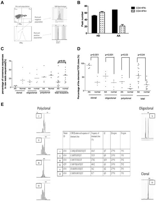 Figure 6. The TCR diversity of Th1 cells was evaluated in 5 pretreatment AA patients (4 with nonsevere disease and 1 with severe disease) and 4 healthy age-matched donors. (A) A hybrid method was used to purify Th1 cells on the basis of their IFN-γ secretion. In the first step, purified CD4+ cells (using negative bead selection) were stimulated in the presence of antibody-coated beads to capture secreted IFN-γ, and the CD4+ IFN-γ–secreting cells were enriched by use of magnetic columns (see Methods). The enriched cells were then further sorted by FACS sorter based on positivity for PE-conjugated anti-IFN-γ. The purity of cells was constantly > 95%. Extracted RNA from these cells was used for cDNA synthesis and PCR for 24 Vβ subfamilies (see “Methods”). The spectratypes of Th1 cells were clonal or oligoclonal in the majority of subfamilies. An example of the spectratypes of IFN-γ+ and IFN-γ− cells are shown. (B) To calculate the diversity of TCR, CDR3 region, the spectratypes of 24 Vβ subfamilies were scored between 1 and 5, based on the number of peaks. The total value was then calculated and used for comparison between samples. As shown, the CD4+ IFN-γ+ cells were less diverse (more clonal) than CD4+ IFN-γ− cells in AA patients, whereas there was no difference between these types in healthy donors (HD). (C) TCR-β diversity determined by percentages of consensus deep-sequencing clusters in total raw reads without data filtering. In general, there was less diversity in AA patients than in normal healthy donors with regard to spectratyping. The clonal diversity was shown to be statistically significant compared with all deep-sequencing data between the 2 groups (P = .03). (D) Comparison of percentages of dominant TCR-β clones between AA patients and normal healthy donors after removal of sequencing errors and combined clones with the same CDR3 amino acid sequences. Significantly higher percentages of TCR-β dominant clones were seen in AA patients (P values shown), which indicates the clonal expansion of TCRs. (E) CD4+ IFN-γ T-cell spectratypes from 2 patients are shown that are either polyclonal (I, II, III, IV), oligoclonal (V), or clonal (VI). Interestingly, in polyclonal spectratypes, large dominant clones (always larger than 25%) were detectable by high-throughput sequencing, which was not the case in healthy donors (C). However, in oligoclonal and clonal spectratypes, the size of the dominant clone was larger in AA patients than in healthy controls (see Figure 6C and supplemental Table 4). Deep sequencing in 2 patients (patient Nos. 6314 and 6235) shown in the figure illustrated immunodominant clones (Vβ7, 9, 2, and 3 in patient 6314 and Vβ1 in patient 6235). The clone size varied from 27% to 81.7% of all reads. Polyclonal spectratypes in AA were clearly associated with immunodominant clones by deep sequencing. Oligoclonal Vβ2 (V) in patient No. 6314 was associated with a clone size of 34.2%, and clonal (VI) spectratype depicted a Vβ3 clone of 81.7%. All dominant clones and the clonal expansions obtained from deep sequencing are shown in the table in panel E. Vβ indicates TCR Vβ chain; CDR3, complementary determining region 3; Jβ, joining region of the TCR-β chain; D region, D region of the TCR-β chain; and UPN, unique patient number.
