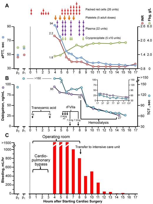 Figure 1. Clinical course of dabigatran-associated massive postcardiac surgery bleeding. (A) Blood products administered, aPTT, INR, and fibrinogen (Fbg) over time. (B) Thrombin-clotting time (TCT) and plasma dabigatran levels. The inset shows TCT and dabigatran levels during the 17- to 137-hour postoperative period. Note: all TCT values shown did not decrease on in vitro addition of protamine (not shown), thus ruling out heparin as an explanation for the patient's prolonged TCTs. (C) Bleeding (chest/pericardial tube output/hr). p2 and p1 refer to blood samples obtained during stable dabigatran dosing 2 and 1 month, respectively, before surgery. rFVIIa indicates recombinant factor VIIa.