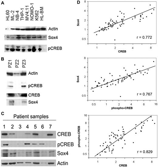 Figure 7. Sox4 and CREB are overexpressed in human AML. (A-C) Western blots with lysates from AML cell lines and pediatric AML bone marrow samples at diagnosis probed with CREB, phospho-CREB, and Sox4 antisera. Sample PZ2 is normal BM control. (D) Sox4 and CREB protein expressions are highly correlated in human AML. Protein expression of Sox4, CREB, and phospho-CREB was quantitated using reverse phase protein array using bone marrow samples from 66 patients with newly diagnosed childhood AML (age range, 0-18 years). Expression is represented as fold change relative to normal bone marrow and displayed on a logarithmic scale. Pearson correlations (r) for log protein expression are significantly different from zero (P < .0001). The first principal component (straight line) accounts for 89% of the total variation.