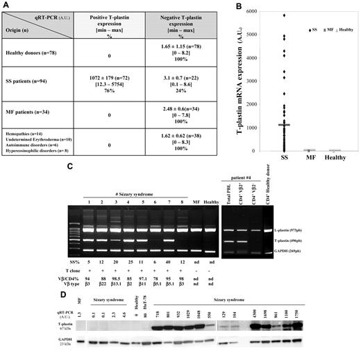 Figure 1. T-plastin mRNA and protein expression in lymphocytes from patients with SS, MF, various hemopathies or undetermined erythroderma and from healthy donors. Total mRNA was extracted from blood lymphocytes of patients with SS (n = 94), MF (n = 34), hemopathies, undetermined erythroderma and scleroderma (n = 38), and of healthy donors (n = 78), purified and used for qRT-PCR (A-D) or multiplex standard PCR (C). Results from qRT-PCR (A-D) are obtained as ΔCt values expressed in arbitrary units (AU) and they are presented as mean ± SEM in panel A, as individual data in panels B through D, and in panel B, with a dark line showing mean values for each set of data. Results in panel C are from multiplex standard PCR of PBLs from 8 SS patients, 1 MF patient, 1 healthy volunteer and for purified CD4+Vβ2+ and CD4+Vβ2− cells from SS patient no. 4 as well as purified CD4+ cells from 1 healthy donor. CD4+ cells were isolated by magnetic-activated cell sorting using the CD4 cell isolation kit (Miltenyi Biotec) and further Vβ2+ isolation using anti-TCR Vβ2 (Clone MPB2D5) from Beckman Coulter and magnetic dynabeads goat anti–mouse IgG. For each CTCL patient are given percentage of Sézary cells (SS%), detection of T cell clone by Vγ-Jγ PCR presented as positive (+) or negative (−), percentage of positive Vβ/CD4 subset and Vβ type obtained by immunophenotyping using flow cytometry (except immunoscope analysis for Vβ6.1). nd indicates not determined. In panel D, under T-plastin mRNA expression obtained by qRT-PCR is shown respective T-plastin protein expression from total extract of PBLs from SS patients (SS, n = 17), 1 MF patient, 1 healthy donor, and HuT-78 cells, as assessed by Western blotting. GAPDH (glyceraldehyde-3-phosphate dehydrogenase) expression is presented as a loading control.