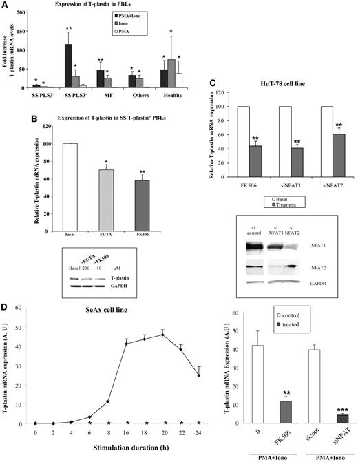 Figure 2. T plastin expression is activated by calcium entry and down-regulated by calcineurin inhibitors and NFAT siRNA. (A) PBLs from patients with SS (n = 40), MF (n = 8), various hemopathies or undetermined erythroderma (others, n = 8), and from healthy donors (healthy, n = 16) were incubated with PMA and ionomycin combination (dark columns), ionomycin (gray columns), PMA (white columns), for 16 hours. For PBLs from patients with SS, 2 sets were distinguished, according to expression of constitutive T-plastin mRNA (SS PLS3+, n = 24) or not (SS PLS3−, n = 16). T-plastin mRNA expression was quantified by qRT-PCR. Results are presented as fold increase of T-plastin mRNA levels detected in stimulated cells relative to basal T-plastin mRNA levels detected in respective unstimulated cells. *P < .05, **P < .01, comparison of T-plastin mRNA levels from stimulated cells to T-plastin mRNA levels from respective nonstimulated cells. (B) Top panel: PBLs from patients with SS (n = 12) that constitutively expressed T-plastin mRNA were treated with EGTA (200μM) or FK-506 (10μM) or not treated (basal) for 16 hours. T-plastin mRNA expression was quantified by qRT-PCR. The constitutive T-plastin mRNA levels measured without treatment was reported to 100 to allow comparison between PBLs from SS patients. Results are presented as mean percentages (± SEM) of T-plastin mRNA levels obtained in the presence of EGTA (light gray bar) or FK506 (dark gray bar) relative to respective T-plastin levels detected in the absence of treatment (white bar). *P < .05, **P < .01, comparison of T-plastin mRNA levels from treated cells to T-plastin mRNA levels from basal nontreated cells. Bottom panel: PBLs from SS patients were not incubated (basal) or incubated with EGTA (200μM) or FK506 (10μM) for 16 hours. T-plastin protein expression was determined by immunoblot analysis with anti–T-plastin antibody and with GAPDH antibody to confirm equal loading. Results are representative of 3 independent experiments. (C) Top panel: HuT-78 cells constitutively expressed T-plastin mRNA. In a set of experiments, cells were preincubated with FK506 (10μM), or not for 16 hours before mRNA extraction. In another set of experiments, HuT-78 cells were transiently transfected with control siRNA (200 or 400nM), siRNA for NFAT1 (200nM), and NFAT2 (400nM) 24 hours before mRNA extraction. T-plastin mRNA expression was quantified by qRT-PCR and results are expressed in relative values of T-plastin expression of treated cells (gray) to respective basal nontreated cells (white) reported as 100 to allow experiment comparison (mean ± SEM, n = 6). **P < .01, comparison of T-plastin mRNA levels from treated cells to T-plastin mRNA levels from respective basal nontreated cells. Bottom panel: HuT-78 cells were transiently transfected with control siRNA (400nM), NFAT1 siRNA (200nM), or NFAT2 siRNA (400nM) 24 hours before total protein extraction was performed. NFAT1 and NFAT2 protein expression was determined by immunoblot analysis with anti-NFAT1 and anti-NFAT2 antibodies and with GAPDH antibody to confirm equal loading. Results are representative of 3 independent experiments. (D) Top panel: SeAx cells (0.2 × 106 cells/mL) were incubated (◊) or not (*) with PMA and ionomycin combination (PMA+Iono) over a 24-hour period (as triplicates) and collected for mRNA extraction at indicated times. T-plastin mRNA expression was quantified by qRT-PCR. Results are expressed in AUs and presented as mean ± SD (n = 3). In the absence of stimulation, SeAx cells did not express T-plastin mRNA (ΔCt values are less than 0.01 AU) whatever the collection time. Bottom panel: Cells were preincubated with FK-506 (10μM) for 1 hour before addition of PMA and ionomycin (PMA+Iono) for further 16 hours. In some experiments, SeAx cells were transiently transfected with control siRNA (200nM) or NFAT1 siRNA (200nM). Eight hours after, transfected cells were stimulated by addition of PMA and ionomycin (PMA+Iono) for 16 hours before mRNA extraction. T-plastin mRNA expression was quantified by qRT-PCR and results are expressed in arbitrary units (AU) and presented as mean ± SEM (n = 6). **P < .01, ***P < .001, comparison of T-plastin mRNA levels from treated cells to T-plastin mRNA levels from respective control cells.