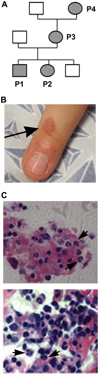 Figure 1. Clinical manifestations in a family with WHIM syndrome. (A) Pedigree consistent with autosomal-dominant inheritance. (B) Representative area of skin warts on patient P1. Arrows point to clusters of representative warts on the dorsum of the right hand. (C) BM biopsy from P1 showing full myeloid maturation in the face of peripheral neutropenia, which is consistent with myelokathexis (400×). Arrows point to representative mature neutrophils and granulocyte precursors and an eyeglass-shaped neutrophil in which pyknotic nuclear lobes were connected by a long filament.