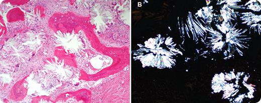 A 28-year-old woman presented with pancytopenia. Her past medical history was significant for primary hyperoxaluria. She had recurrent renal stones and urinary tract infections since the age of 5 years. Subsequently she developed uremic symptoms with end-stage renal disease. For the past 5 years she required regular hemodialysis and transfusions. There was no history of joint pain, cardiac problems, or brain sequelae of oxalosis. On physical examination she had massive hepatosplenomegaly but no lymphadenopathy. Liver enzymes and bilirubin were normal and studies for viral hepatitis were negative. Liver biopsy documented secondary hemochromatosis (transfusion dependent). Laboratory studies showed pancytopenia with hemoglobin of 63g/L, a white blood cell count of 2.6 × 109/L, and a platelet count of 106 × 109/L. Peripheral blood film showed leukoerythroblastic picture with teardrop poikilocytosis. The anemia persisted with little, if any, response to erythropoietin, despite the use of high-dose erythropoietin (100 000 units 4 times per week). Bone marrow biopsy revealed replacement by extensive gray-white crystal deposition (panel A). The crystals were birefringent under polarized light (panel B). / Bone marrow oxalate deposition has been associated with variable degrees of cytopenias, leukoerythroblastic picture, and hepatosplenomegaly. In some patients, as in this case, bone marrow oxalosis can result in resistance to erythropoietin.