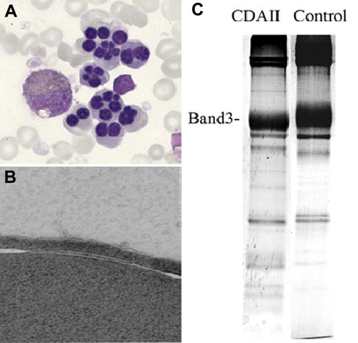 Figure 5. Abnormal findings in CDAII. (A) Bi- and multinucleated erythroblasts on BM light microscopy. (B) Erythroblast “double membranes” on electron microscopy. (C) Faster than normal shift of the RBC membrane band 3 protein on SDS-PAGE. Adapted from Denecke and Marquardt76 with permission.