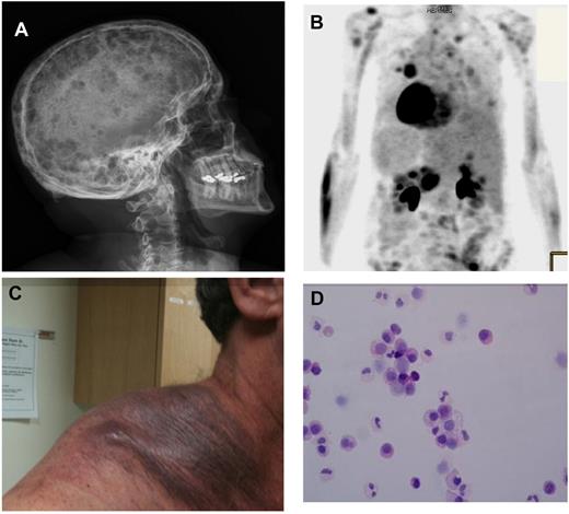 Figure 1. Clinical presentations of cell dissemination and metastasis in MM. (A) Skeletal survey showing multiple lytic lesions in the skull of a patient diagnosed with symptomatic multiple myeloma (MM). These multiple lesions represent multiple sites of growth of MM cells within the BM niches in the skull. (B) A PET scan showing multiple areas of enhancement in a patient with extramedullary MM, indicating that MM cells can metastasize to areas outside the BM in a subgroup of patients with extramedullary MM. (C) Extramedullary MM presenting as a large subcutaneous mass on the shoulder of a patient with advanced disease. (D) Circulating tumor plasma cells observed in a patient with MM demonstrating that a small number of tumor cells are continuously circulating in the peripheral blood leading to cell dissemination. This patient does not have plasma cell leukemia.