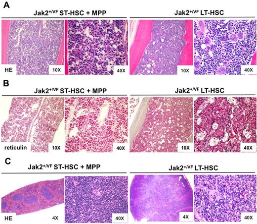 Figure 4. Mice transplanted with Jak2V617F mutant LT-HSCs develop MPN and myelofibrosis. (A) Histopathologic (HE) sections of BM from a representative mouse transplanted with Jak2+/VF ST-HSC + MPP cells (n = 4 in group) or Jak2+/VF LT-HSC cells (n = 3 in group), demonstrating diffuse erythroid hyperplasia and megakaryocyte hyperplasia in the Jak2+/VF LT-HSC recipient. The Jak2+/VF LT-HSC recipient also shows evidence of megakaryocytic clustering, enlarged forms with bizarre, hypernucleated nuclei, marked emperipolesis, and abnormal megakaryocyte localization in marrow sinuses or in association with trabecular bone. These abnormalities are not seen in the Jak2+/VF ST-HSC + MPP recipient. (B) Reticulin sections of BM from a representative mouse transplanted with Jak2+/VF ST-HSC + MPP cells (n = 4 in group) or Jak2+/VF LT-HSC cells (n = 3 in group), demonstrating a fine reticulin fiber network with crossing fibers deposition consistent with grade 1-2 reticulin fibrosis in the Jak2+/VF LT-HSC recipient. These abnormalities are not seen in the Jak2+/VF ST-HSC + MPP recipient. (C) Histopathologic (HE) sections of spleen from a representative mouse transplanted with Jak2+/VF ST-HSC + MPP cells (n = 4 in group) or Jak2+/VF LT-HSC cells (n = 3 in group), demonstrating erythroid hyperplasia and megakaryocyte hyperplasia with clustering and atypical nuclear features in the Jak2+/VF LT-HSC recipient. These abnormalities are not seen in the Jak2+/VF ST-HSC + MPP recipient.