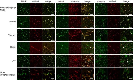 Figure 1. PAL-E antigen colocalizes with PV-1 and NRP-1. The 2-color immunofluorescent stainings of the indicated human tissues using anti–PV-1, anti–NRP-1, and PAL-E antibodies were performed as described in “Immunostainings” and, in more detail, in supplemental Methods. White arrows indicate the structures, which are positively stained by anti–NRP-1 antibodies but negative for both anti–PV-1 and PAL-E. Original magnifications ×200. Scale bars represent 100 μm.
