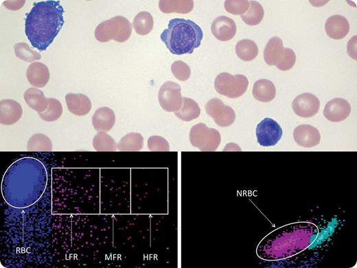 A 47-year-old man with a 5-year history of Jak-2-positive polycythemia vera, previously treated with phlebotomy and hydroxyurea, presented with bone pain, fever, and night sweats. Physical examination was normal. Laboratory examination revealed pancytopenia (hemoglobin 78 g/L, leukocytes 2.5 × 109/L, platelets 30 × 109/L) and 9% myeloblasts. The myeloblasts coexpressed CD34/CD33/CD13/CD117/HLA-DR and the bone marrow biopsy showed glycophorin A and CD117 positive blasts. Lactate dehydrogenase, alkaline phosphatase, and γ-glutamyltransferase were elevated; bilirubin and transaminases were normal. / Numerous erythroblasts were seen (top panel) in the peripheral smear (240/100 leukocytes), whereas the reticulocyte count was reduced (20.8 × 109/L). High fluorescence reticulocytes (HFRs), the less differentiated reticulocytes with the highest RNA content, were only 0.6%, middle fluorescence reticulocytes (MFRs) were 11%, and low fluorescence reticulocytes (LFRs), the most differentiated reticulocytes with the lowest RNA content, were 88.4% (bottom panels). When high erythroblast counts appear with hemolytic anemia, an elevated HFR level occurs because erythroblasts are maturing to reticulocytes. This patient had a low HFR level despite a high erythroblast count, indicating a block of red blood cell maturation. A diagnosis of acute erythroid leukemia with previous polycythemia vera was made. The patient did not respond to 5-azacytidine and died 3 months after diagnosis.
