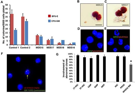 Figure 2. Cytogenetic alterations are seen in MDS HSCs. (A) Colony formation assay using sorted Lin−CD34+CD38− cells from 4 MDS patients and 2 healthy controls. Data are mean ± SD for colonies arising from BFU-E and CFU-GM per 5000 plated cells. (B-C) Microscopic image of MDS patient-derived, sorted Lin−CD34+CD38− cells grown in the semisolid culture for 12 days. DiffQuick staining of cytospun cells. Scale bar represents 50 μm. (D-E) FISH analysis of day 12 colonies from 2 patients with MDS. (F) Sorted HSCs from 1 patient with MDS showing monosomy of chromosome 7 in the majority of cells and 1 cell (yellow arrow) with both copies of chromosome 7 (red probe for 7q31 and centromeric green probe). (G) Mean percentages and SEM of abnormal karyotypic clones in lower-risk MDS HSC and progenitor compartments. Gray bar represents the results obtained from whole BM from the clinical diagnostic laboratory. *P < .05 (2-tailed t test).