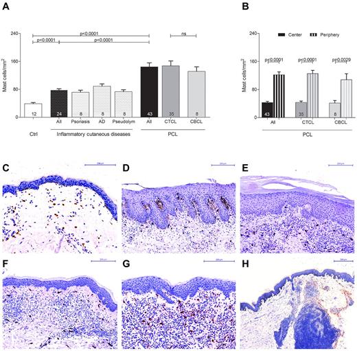 Figure 1. Increased number of mast cells in PCL. (A) Skin biopsies from patients with PCL (All; n = 43) subdivided into patients with CTCL (n = 35) and CBCL (n = 8), from subjects with normal skin (Ctrl; n = 12) and from patients with inflammatory cutaneous diseases (All; n = 24), such as psoriasis (n = 8), atopic dermatitis (AD; n = 8) and pseudolymphoma (Pseudolym; n = 8) were stained by immunohistochemistry with anti-tryptase antibody. The number of tryptase-positive mast cells was analyzed by microscopic counting of 5 high power fields at 200× magnification and calculating the mean number of mast cells per mm2. Data represent the mean ± SEM. Statistical significance was assessed by 2-tailed Student t test. (B) The number of tryptase-positive mast cells was counted separately in the center (filled columns) and in the periphery (striped columns) of PCLs. Data represent the mean ± SEM. Statistical significance was assessed by 2-tailed Student t test. (C) Normal skin, magnification 200×. (D) Psoriasis, magnification 150×. (E) Atopic dermatitis, magnification 150×. (F) Pseudolymphoma, magnification 150×. (G) CTCL, plaque stage, magnification 200×. (H) CTCL, tumor stage, magnification 50×, staining of mast cells with anti-tryptase antibody (brown).