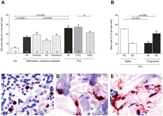 Figure 3. Increased degranulation of mast cells in PCL. Degranulation of mast cells stained with anti-tryptase antibody was evaluated semiquantitatively at 200× magnification in skin biopsies from PCL patients, patients with inflammatory cutaneous diseases and control subjects and graded as (C) not degranulated, (D) moderately degranulated, and (E) extensively degranulated. (A) Extensively degranulated (ED) mast cells were counted in 3 high power fields at 200× magnification in skin biopsies from patients with PCL (All; n = 43) subdivided into patients with CTCL (n = 35) and CBCL (n = 8), from subjects with normal skin (Ctrl; n = 12) and from patients with inflammatory cutaneous diseases (All; n = 24), such as psoriasis (n = 8), atopic dermatitis (AD; n = 8), and pseudolymphoma (Pseudolym; n = 8). Results are presented as percentage of ED mast cells of all mast cells and expressed as mean ± SEM. Statistical significance was assessed by 2-tailed Student t test. (B) ND mast cells and ED mast cells were counted in skin biopsies from patients with stable PCL (n = 32) and progressive PCL (n = 11). Data represent the mean ± SEM. Statistical significance was assessed by 2-tailed Student t test.