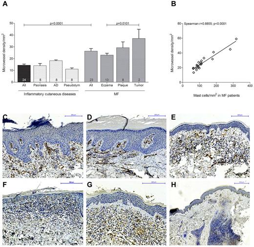 Figure 4. Increased microvessel density in MF. (A) Skin biopsies from patients with MF (All; n = 23) subdivided into MF stages eczema (n = 13), plaque (n = 8), and tumor (n = 2) and from patients with inflammatory cutaneous diseases (All; n = 24) such as psoriasis (n = 8), atopic dermatitis (AD; n = 8), and pseudolymphoma (Pseudolym; n = 8) were stained by immunohistochemistry with anti-CD31 antibody. The number of CD31-positive microvessels (lumen > 50 μm2) was analyzed by microscopic counting of 5 high power fields at 100× magnification and calculating the mean number of microvessels per mm2. Data represent the mean ± SEM. Statistical significance was assessed by 2-tailed Student t test. (B) Microvessel density per mm2 (y-axis) positively correlates with mast cell number per mm2 (x-axis) in MF patients (n = 23; Spearman r = 0.8855; P < .0001). (C) Psoriasis, magnification 150×. (D) Atopic dermatitis, magnification 150×. (E) Pseudolymphoma, magnification 150×. (F) CTCL, eczema stage, magnification 200×. (G) CTCL, plaque stage, magnification 200×. (H) CTCL, tumor stage, magnification 50×, staining of microvessels with anti-CD31 antibody (brown).