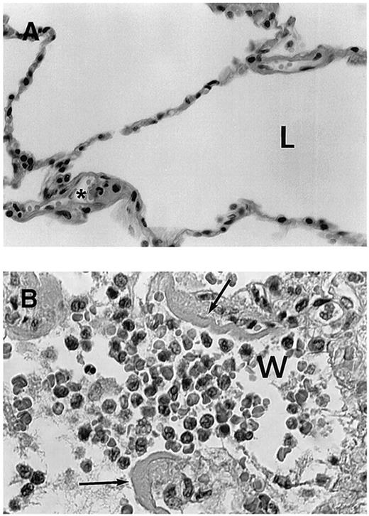 Figure 1. Histologic findings in cases with fatal retinoic acid syndrome. (A) Histologic appearance of normal lung tissue. L indicates lung alveolae in normal lung. *Normal neutrophil in microvasculature. (B) Lung tissue showing infiltration of alveolae with leukocytes from a patient who died of retinoic acid syndrome. w indicates myeloid cells in the airspace (most leukocytes to left of “w”); the lobated nuclei of myeloid cells is prominently seen. Arrows indicate fibrinous exudate resulting from vascular leak of serum fibrin. Data from Tallman et al.37