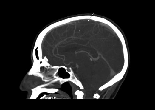 Figure 2. CT scan. Sagittal plane demonstrating sagittal sinus. The arrow indicates the filling defect corresponding to sagittal sinus thrombosis.