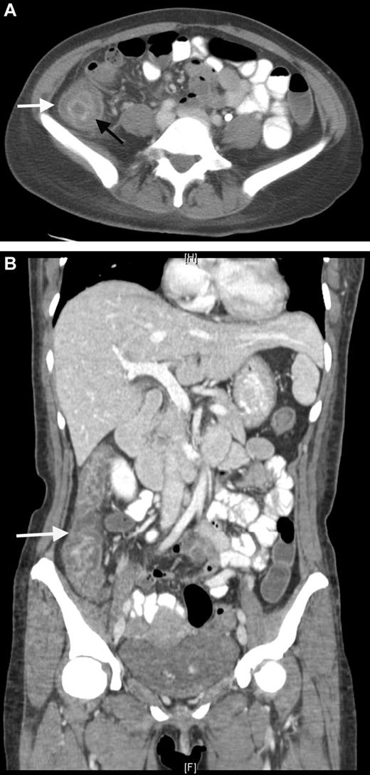 Figure 3. CT scan. Neutropenic enterocolitis. (A) Coronal contrast-enhanced CT image through the abdomen and pelvis. Coronal contrast-enhanced CT demonstrates bowel wall thickening with low attenuation in the submucosal layer of the bowel wall representing bowel wall edema. (B) Axial contrast-enhanced CT through the abdomen. Axial contrast-enhanced CT through the abdomen demonstrates bowel wall thickening with a “target sign” in the ascending colon. The mucosa and muscularis layers are hyperenhancing, whereas the submucosal low density represents bowel wall edema.