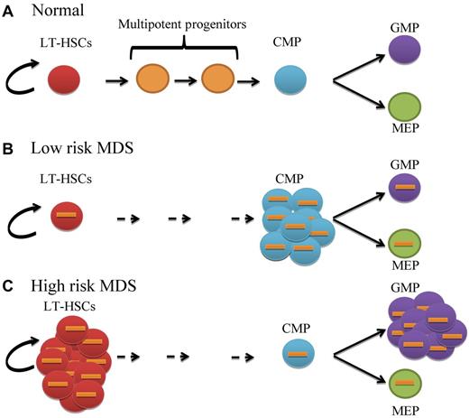Stage-specific aberrant expansion or differentiation block of distinct stem and progenitor populations in MDS. (A) Normal primitive long-term hematopoietic stem cells (LT-HSCs; red circles) have the capacity for self-renewal and give rise to a balanced number of multipotent progenitors (orange circles), common myeloid progenitors (CMPs; blue circles), granulocyte-monocyte progenitors (GMPs; purple circles) and megakaryocyte-erythrocyte progenitors (MEPs; green circles). (B) Low risk MDS LT-HSCs are cytogenetically abnormal (orange bars) with expansion of CMPs but normal GMP and MEP distribution. (C) High-risk MDS LT-HSCs are significantly expanded with increased GMP and slightly reduced MEP compartments. Status of multipotent progenitors in low- and high-risk patients has not been evaluated in this study.