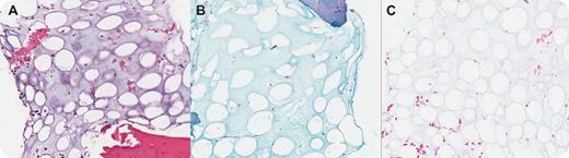 A 69-year-old man developed fatigue, dyspnea, expanding girth, night sweats, and weight loss. On examination he had ascites and peripheral edema. He had normocytic anemia (hemoglobin 8.2 g/dL), normal white count, minimal lymphopenia, normal platelet count, and a normal peripheral smear. Lactate dehydrogenase was 7500 u/L and serum proteins noted with mild hypoalbuminemia and marked hypogammaglobulinemia (0.24 g/dL). The ascitic fluid showed lymphoma cells. Computed tomography showed pleural effusions, ascites, and abdominal and mediastinal masses. An abdominal lymph node biopsy made the diagnosis of B-cell lymphoma, unclassifiable, with features intermediate between diffuse large B-cell lymphoma and Burkitt lymphoma. The bone marrow aspirate revealed trilineage hematopoiesis and poorly stained acellular material. The bone marrow biopsy showed extensive gelatinous transformation characterized by extracellular deposits of amorphous, smooth, gelatinous material (panel A; HE), rich in hyaluronic acid that was Alcian Blue stain positive (panel B). After treatment with hyaluronidase (panel C; Alcian Blue with Hyaluronidase) the stain became negative. Combination chemotherapy resulted in clinical remission. No posttherapy bone marrow biopsy has been performed. / Gelatinous transformation or serous fat atrophy has been described in cancer-related cachexia and end-stage renal disease. It has since been noted with myxedema, anorexia nervosa, infections, and malignant neoplasms, including lymphoma. Currently it is mostly noted in anorexia nervosa, predominantly in marathon runners, and in end-stage AIDS. Gelatinous transformation of the bone marrow is uncommon but it can be identified by radiologists on magnetic resonance imaging (MRI). There were no MRIs performed on this patient.
