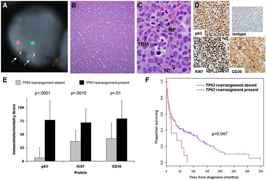 Figure 4. Clinicopathologic findings in peripheral T-cell lymphomas with TP63 rearrangements. (A) Dual-fusion (D-) and/or breakapart FISH probes were used to screen 190 PTCLs for TP63 rearrangements. In this case, D-FISH showed 2 abnormal fusion signals (arrows), corresponding to fusion of TBL1XR1 (green) to TP63 (red). The remaining green and red signals represent the nonrearranged copies of TBL1XR1 and TP63, respectively. (B) Most PTCLs with TP63 rearrangements showed a diffuse, sheet-like growth pattern (hematoxylin and eosin, 100× magnification; image acquired using an Olympus DP71 camera and Olympus BX51 microscope). (C) All rearranged cases demonstrated apoptotic debris, and 4 of 11 cases had prominent tingible body macrophages (TBM) phagocytozing cellular debris (1000×). Mitotic figures (MF) also were present. TC indicates tumor cells. (D) Immunohistochemistry of the tumor shown in panels A through C shows strong, uniform nuclear staining for p63 protein (400×). Virtually all tumor cells express the proliferation marker Ki67, as well as the lymphocyte activation marker, CD30. Top right panel indicates isotype control antibody. (E) Associations between TP63 rearrangement and results of immunohistochemical studies. (F) PTCL patients with TP63 rearrangements (n = 11) had significantly poorer overall survival than those without TP63 rearrangements (n = 179; median survival with and without rearrangements, 17.9 months vs 33.4 months, respectively).