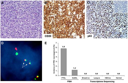 Figure 5. TP63 rearrangements in DLBCLs. (A) DLBCL with TP63 rearrangement (hematoxylin and eosin, 400×). (B) Immunohistochemistry for the B-cell antigen, CD20 (400×). (C) Tumor cells showed strong nuclear expression of p63 protein (400×; inset, isotype control). (D) Dual-fusion FISH showed 2 fusion signals (arrows), corresponding to TBL1XR1/TP63 fusion. (E) TP63 rearrangements were seen in 1.2% of DLBCLs by FISH. The SnowShoes fusion detection algorithm did not identify TP63 fusions in transcriptome data from carcinomas (ca) of the breast, lung, or head and neck (H&N), nor in data from normal controls.