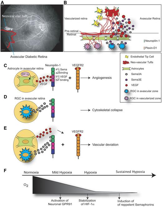 Figure 5. Neuronal influence in retinal ischemic disease. In ischemic retinopathies such as that of diabetes, regional microvascular decay yields zones of avascular neural tissue. (A) Angiogram of a human patient with DR. The red line delineates a zone of microcapillary loss with adjacent preretinal proliferation (white neovascular tuft). (Image courtesy of Dr Andreas Stahl, University Eye Hospital Freiburg.) (B) The schematic illustrates that in the avascular retina, hypoxic RGCs produce vasorepulsive semaphorins that repel nascent vessels into the vitreous and away from avascular zones of the retina. (C) Although ischemic astrocytes in the avascular retina produce VEGF via a HIF-2α–mediated mechanism, severely ischemic retinal ganglion neurons produce semaphorin 3A (D) and semaphorin 3E. (E) Astrocyte-derived VEGF stimulates vessel growth, whereas RGC-derived semaphorin 3A and 3E deviate vessels and thus impede reparative angiogenesis by repelling neovessels away from the avascular neural-retina toward the vitreous. (F) Hypoxia/ischemia is a major promoter of angiogenesis through mechanisms such as metabolite signaling and HIF-1α stabilization. When hypoxia persists and neurons are driven beyond a metabolic threshold, they revert to producing classic neuronal repulsive cues such as semaphorin 3A and 3E.