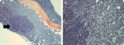 A 59-year-old male was diagnosed with stage IVB mantle cell lymphoma after presenting with night sweats and thrombocytopenia, generalized lymphadenopathy, and splenomegaly. He also had gastrointestinal and bone marrow involvement and multiple sites of osseous disease. The white cell count (WBC) was 5.7 × 109/L with 51% lymphocytes, hemoglobin 12.2 g/dL, and platelets 38 × 109/L. Ten days later and 1 day after dexamethasone initiation, the WBC was 46.8 × 109/L. Peripheral blood flow cytometry revealed intensely CD20 positive, CD5 negative blastoid monoclonal B lymphocytes. / A repeat bone marrow biopsy showed the lymphoma in the process of blastic transformation. (see figure). The marrow was replaced by a lymphoid infiltrate of 2 distinct components. One was made up of small, round lymphocytes with a mature chromatin pattern forming nodules (arrow); the other, sheets of large cells with irregular nuclear contours, a finer chromatin pattern, and frequent mitoses. A CD20 stain was intensely positive for membrane staining in both populations; CD5 immunostain showed dim surface expression within the small cells and loss in the larger cells. A diagnosis was made of mantle cell lymphoma with blastic transformation.