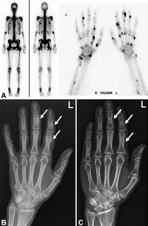 Figure 1. Radiographic findings and bone scintigraphy in patient 1. (A) Technetium 99m-methyl-diphosphonate bone scintigraphy showing marked tracer uptake in the entire skeleton, most pronounced in the spine and pelvis (left). There are multiple active spots in bones of both hands (right). (B) Plain film showing marked periosteal bone apposition on diaphysis of the phalanges of the left hand (arrows). Findings are typical for hypertrophic osteoarthropathy. The image was taken after 9 months of voriconazole therapy. (C) Plain film showing resolution of periosteal bone appositions on diaphysis of the phalanges (arrows). The image was taken 5 years after cessation of voriconazole therapy.