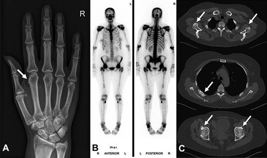 Figure 2. Radiographic findings and bone scintigraphy in patient 2. (A) Plain film showing marked periosteal bone apposition on radial and distal diaphysis of the first metacarpal bone of the right hand (arrow). (B) Technetium 99m-methyl-diphosphonate bone scintigraphy showing marked tracer uptake in the entire skeleton, most pronounced in the spine and pelvis. There are active spots in bones of both hands and feet. (C) CT scan of the entire skeleton revealed bone appositions in various sites of the skeleton (arrows): at the caudal margin of the glenoid (top), at the dorsal ribs (middle), and periacetabular on both sides (bottom). Findings are typical of hypertrophic osteoarthropathy.