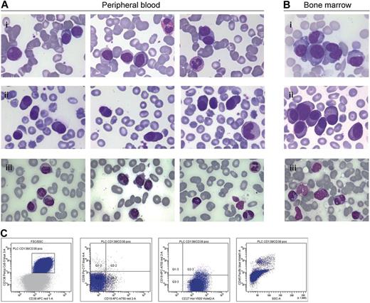 Figure 3. Peripheral blood and BM features of pPCL. (A) May-Grünwald-Giemsa staining of peripheral blood smears from 3 different patients with pPCL. (i) The peripheral blood smear of patient 1 is characterized by the presence of circulating plasma cells, including binucleated cells. Some plasma cells have a lymphoplasmacytoid appearance. There is also rouleaux formation and leuko-erythroblastosis (myelocyte in Ai). Cytogenetic analysis demonstrated the presence of an IgH translocation with an unknown partner chromosome as well as deletion of the Y chromosome. (ii) Peripheral blood of patient 2 contains circulating plasma cells, some of which have 2 nuclei or a lymphoplasmacytoid aspect. FISH analysis showed the presence of t(14;16) and ampl(1q21). (iii) The staining of patient 3 shows very atypical circulating plasma cells often with a monocytic appearance. Numerous cells contain cytoplasmic (Russell bodies) and intranuclear inclusions (Dutcher bodies). Cytogenetic analysis revealed multiple deletions, including chromosomes 6q, 12p, 13, 16, and 20, and the presence of t(14;20). (B) May-Grünwald-Giemsa-stained BM smears from the same 3 pPCL (i-iii) patients. (C) Immunophenotypic analysis of the leukemic plasma cells from the patient shown in subpanels Aii and Bii. The tumor cells are positive for CD138 and CD27, weakly positive for CD38 and CD45, and negative for CD56 and CD19. Cells were also negative for CD20 (not shown).