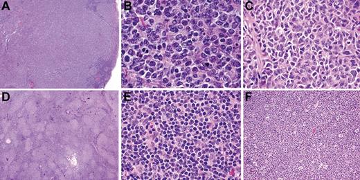 Figure 1. Histologic features of FL in children and young adults (cohort 1). All cases showed at least partial architectural effacement by a follicular proliferation. In 1 representative case, there are large, expansile, and coalescent follicles (A) composed of small- to medium-sized centrocytes and numerous medium- to large-sized centroblasts (B), consistent with histologic grade 3A (B). In a second case (C), medium-sized centrocytes predominate and centroblasts are uncommon. The neoplastic infiltrate of a third case is composed of relatively small follicles (D), composed predominantly of small centrocytes (E). “Starry-sky” appearance, as illustrated in a fourth case (F), was frequent. Images were captured at ×40 magnification (A,D); at ×100 magnification (F); and at ×400 magnification (B,C,E) with the use of an Olympus, BX53 microscope, Olympus DP25 digital camera.