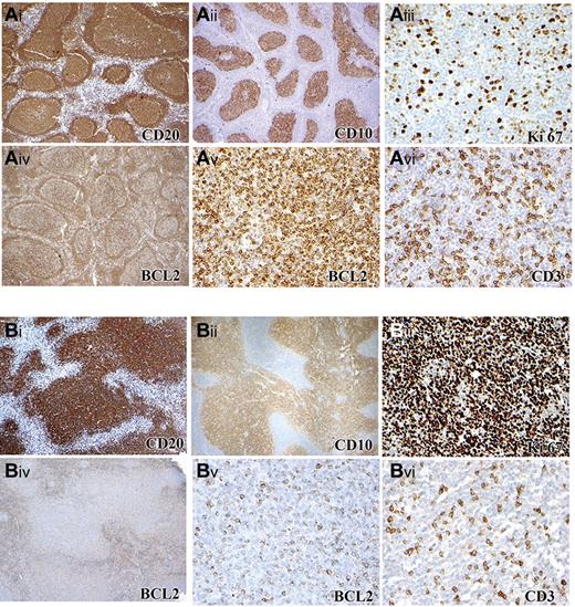 Figure 2. Immunophenotype of FL in children and young adults (cohort 1). (A) Case with BCL2 rearrangement and low PI composed of CD20+ (Ai), CD10+ (Aii) follicles with a low Ki67 PI (Aiii) that are BCL2 positive (Aiv). Higher-power image of BCL2 (Av) and CD3 (Avi) staining of the same area shows 4+ BCL2 staining intensity. (B) Case with no BCL2 rearrangement and with HPI composed of an expansile follicular proliferation of CD20+ (Bi), CD10+ (Bii) follicles with a high Ki67 PI (Biii) Ki-67 and with some expression of BCL2 (Biv). Higher-power image of BCL2 (Bv) and CD3 (Bvi) staining of the same area, showing 2+ BCL2 staining intensity. Panels Ai-ii, Aiv, Bi-ii, and Biv were captured at ×40 magnification and Aiii, Av-vi, Biii, and Bv-vi at ×200 magnification with the use of an Olympus, BX53 microscope, Olympus DP25 digital camera.