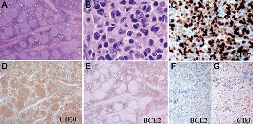 Figure 4. Pediatric-type FL (cohort 1) with unusual morphologic features. Some FL cases lacking BCL2 rearrangement and with HPI were composed of small follicles (A) containing predominantly small centrocytes and few centroblasts (B). The Ki67 proliferation index is high (C), and the CD20+cells (D) lack expression of BCL2 protein (E). Higher-power image of BCL2 (F) and CD3 (G) staining of same field shows no expression of BCL2. Panels A, D, and E were captured at ×40 magnification; F and G at ×100 magnification; B at ×1000, and C at ×400 magnification with the use of an Olympus, BX53 microscope, Olympus DP25 digital camera.