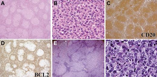 Figure 5. Morphologic and IHC features of pediatric-type FL in adults. Representative example of a pediatric-type FL from an adult (cohort 2). The follicular proliferation is composed of variably sized follicles (A) with increased centroblasts, consistent with grade 3A (B). The follicles are composed of CD20+ B cells (C) that do not express BCL2 protein (D). (E, F) One patient with FL in cohort 2 had grade 3B histology. This lymphoma contained large, expansile follicles (E) composed of a uniform population of large centroblasts (F). Panels A, C, D, and E were captured at ×40 magnification; and B and F at ×400 magnification with the use of an Olympus, BX53 microscope, Olympus DP25 digital camera.