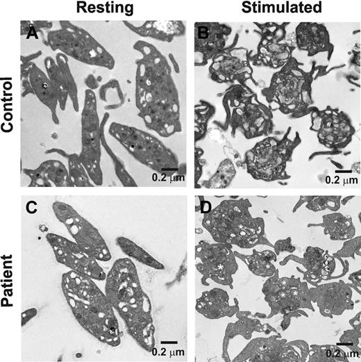 Figure 4. The ultrastructure of resting and stimulated platelets from a FHL5/Munc18b/STXBP2 patient. Platelets from a biallelic patient (P1; A and C) and normal control (B and D) were prepared as described under “Ultrastructure analysis.” (A and B) Platelets under resting conditions. Thrombin (final concentration 0.1 U/mL) was added to samples shown in panels C and D. After 2 minutes at room temperature, samples were fixed and analyzed by transmission electron microscopy. (D) Some α-granules are marked with white asterisks. The scale bar is indicated in all images.