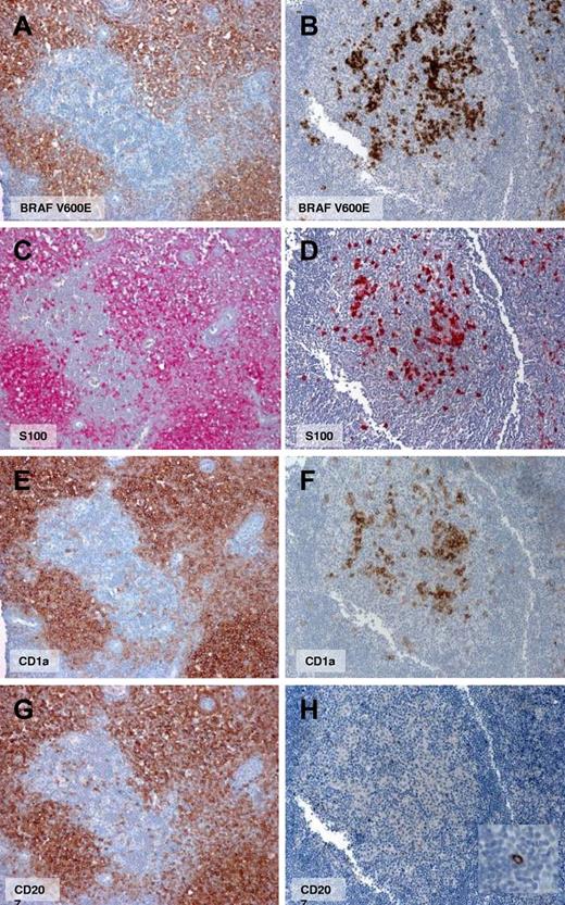 Figure 1. Immunohistochemistry for BRAFV600E, CD1a, CD207, and S-100 in serial sections of 2 representative cases. One reveals high overlap between mutant and CD207-positive cells (case 9, left panels), and the other reveals a minority of mutant cells expressing CD207 (case 19, right panels, ×10 lens).