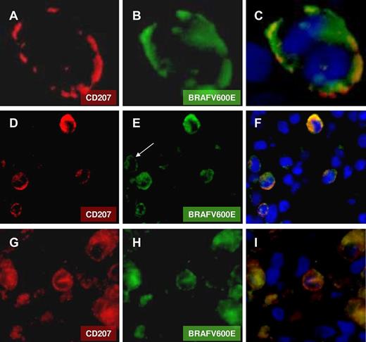 Figure 2. Representative immunofluorescent labeling. (A,D,G) CD207. (B,E,H) BRAFV600E. The left and central panels underline the wide overlap of mutant protein and CD207-expressing cells. (C,F,I) Overlay. Arrow indicates mutant BRAFV600E protein in a cell without signal for CD207.