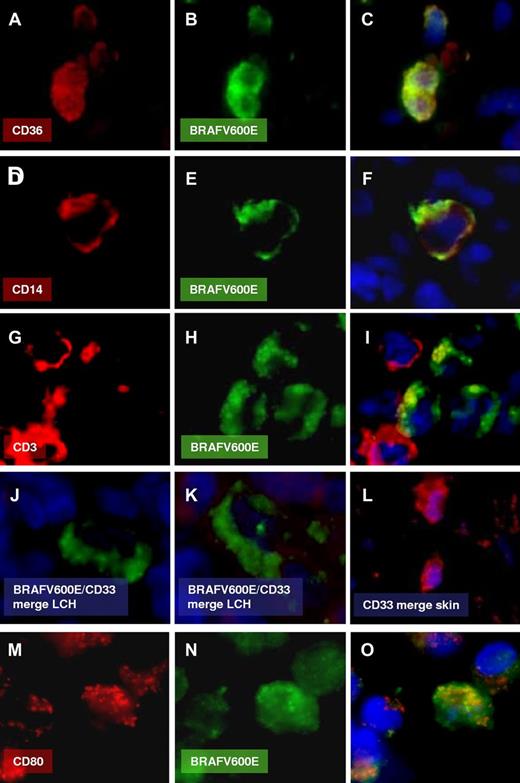 Figure 3. Representative immunofluorescence. BRAFV600E combined with antibodies against CD36 (A-C), CD14 (D-F), CD3 (G-I), CD33 (J-K; skin sample stained for CD33 as positive control, L), and CD80 (M-O).