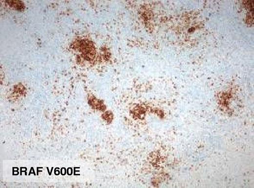 Figure 5. Case with binding of mutation-specific antibody but no mutation detectable by sequencing (case 20, ×4 lens).