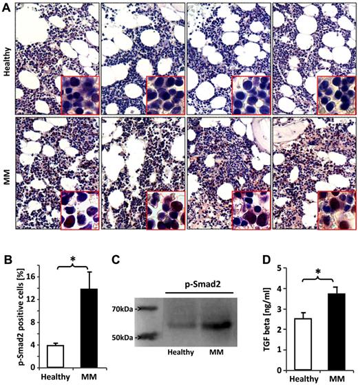 Figure 4. Smad2 is overactivated in BM cells and HSPCs of MM patients. BM biopsy sections from patients with MM and healthy controls were fixed and immunostained with an Ab against phospho-smad2, the activated form of the downstream mediator of TGFβ receptor I kinase (TBRI) activation. (A) Four representative samples of healthy donors and MM patients, respectively. P-smad2 staining was quantified by counting the total number of positively stained cells in 3 hot fields for each patient sample under ×200 magnification aided by Motic Image Plus software. (B) The bar chart shows the mean percentage of phospho-smad2–positive BM cells in healthy donors and MM patients. HSPCs from the BM of healthy donors and MM patients were assessed for smad2 phosphorylation by immunoblotting. (C) One representative of 4 experiments is shown. TGFβ1 concentrations were assessed by ELISA. (D) The bar charts display the mean TGFβ1 concentration in the BMEF. The Student t test was used to detect statistically significant differences. *P < .05.