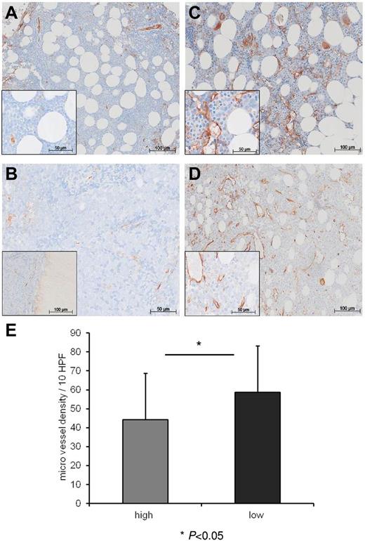 Figure 5. Vasostatin levels inversely correlate with MVD in patients with AML. Immunohistochemical staining of bone marrow biopsies with von VWF identifying endothelial vessel structures (stained brown). Panels A and B represent 2 patients with high vasostatin levels and low MVD, whereas panels C and D depict 2 patients with low CRT serum levels and high MVD. Inlays reveal greater magnification of the individual overview images. Panel E depicts the number of microvessels (enumerated in the VWF staining) per 10 HPF in the individual bone marrow biopsies (P = .0495; mean ± SD; high vasostatin levels: 44 ± 25/10 HPF vs low vasostatin levels: 59 ± 24/10 HPF).