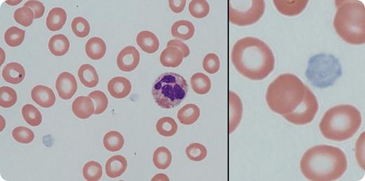 A 7-year-old boy of Pakistani origin was referred for thrombocytopenia and possible IgA deficiency. His medical history was significant for frequent upper respiratory tract infections and otitis media. There was no history of epistaxis, oropharyngeal bleeding, petechiae, bruising, or other bleeding problems. Physical examination was normal with no evidence of hepatosplenomegaly. Laboratory evaluation revealed hemoglobin 129 g/L, white blood cell count 7.4 × 109/L, and platelet count 58 × 109/L. There was no family history of thrombocytopenia or bleeding; both parents (unrelated) and a sibling had normal platelet counts. Peripheral blood film examination (see figure) revealed large pale platelets, suggesting a diagnosis of gray platelet syndrome, which was confirmed by electron microscopy. Next-generation sequencing of platelet RNA demonstrated intron retention in NBEAL2 transcripts. Genomic DNA sequencing confirmed compound heterozygous mutation of NBEAL2, which produces a protein predicted to be involved in megakaryocyte vesicular trafficking. / Autosomal recessive inherited gray platelet syndrome was first described in 1971 by Raccuglia in patients having macrothrombocytopenia and mild to moderate bleeding. Most of the patients later develop splenomegaly and myelofibrosis. The diagnosis of this disorder is first considered by the presence of pale-appearing platelets on a peripheral blood smear. Confirmation is made by electron microscopy that shows an absence of platelet α-granules.