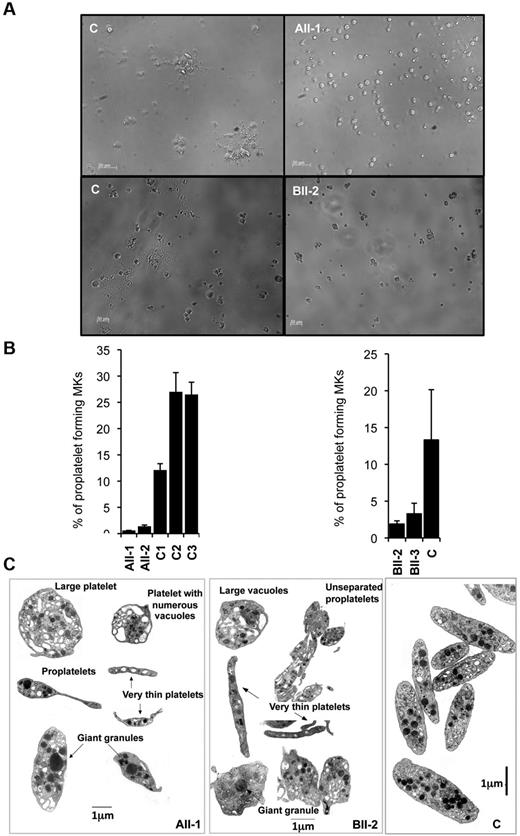 Figure 2. Effect of RUNX1 mutations on MK differentiation and proplatelet formation. (A-B) CD34+ cells from AII-1, AII-2, BII-2, and BII-3 patients and control individuals were grown in liquid medium supplemented with TPO, IL-3, IL-6, SCF, and FLT3-L. C1, C2, and C3 were grown simultaneously with AII-1 and AII-2, and C was grown simultaneously with BII-2 and BII-3. CD41+CD42+ cells were sorted at day 10 of culture and seeded at 2 × 103 cells/well in 96-well plate. The percentage of proplatelet forming MKs was estimated at day 13. (A) Representative microscopic images representing control and patients proplatelet forming MKs. (B) The percentage of proplatelet forming MKs was estimated by counting MKs exhibiting 1 or more cytoplasmic processes with areas of constriction. A total of 500 cells per well was counted. The histograms show 1 representative experiment of 3, each in triplicate. Error bars represent ± SD of triplicate (n = 3, P < .05). (C) Ultrastructural aspect of blood platelets from AII-1 and BII-2 patients. Gallery of photographs illustrating the typical platelet abnormalities: large heterogeneity in size with both round enlarged and small thin platelets, presence of giant granules and large vacuoles, presence of incompletely fragmented proplatelets. Similar results were obtained in 3 repeated experiments.