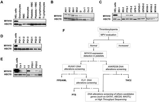 Figure 1. MYH10 detection in platelets from patients with inherited thrombocytopenia. (A-E) Immunoblot analysis of MHYH10 expression. In all panels, HEL cells were used as positive controls and HSC70 as loading control. (A) Indicated peripheral blood cell populations from a healthy donor. Platelets − RBC indicates platelets after depletion of RBCs; and Platelets + RBC, platelets without RBC depletion. One representative of 2 experiments is shown. (B) Platelets of FPD/AML patients (AII-1 and AII-2 with R174Q RUNX1 mutation; BII-2 and BIII-1 with R139X RUNX1 mutation; and D with RUNX1 monoallelic deletion) and healthy donors as controls (Co1-3). (C) Platelets of patients with well-identified inherited thrombocytopenia. BS indicates Bernard-Soulier syndrome; GPS, Gray platelet syndrome; GPIVD, thrombocytopenia associated with GPIV defect; and MYH9, thrombocytopenia associated with MYH9 mutations. (D) Platelets of patients from 2 pedigrees (PG1 and PG2, 3 patients in each) with unexplained thrombocytopenia with increased mean platelet volume. (E) Platelets of patients with unexplained thrombocytopenia with normal mean platelet volume. Two patients from the same pedigree are included (PG3). (F) Flowchart of familial thrombocytopenia diagnosis based on MYH10 detection in platelets.