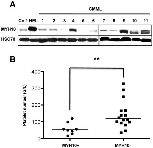 Figure 2. MYH10 detection in platelets from CMML patients. (A) Immunoblot analysis of MYH10 expression in platelets from patients with CMML. HEL cells were used as positive controls, Co 1 platelets as negative control, and HSC70 as loading control. (B) Statistical evaluation of correlation between MYH10 presence in platelets of patients with CMML, RCMD, AML-M4, and reactive monocytosis and thrombopenia degree. MYH10+ indicates patients with the presence of MYH10 in platelets; and MYH10−, patients with the absence of MYH10 in platelets. **P < .007 (Mann-Whitney U test). Statistical analyses were carried out with Prism, Version 5.0 (Graphpad Software).